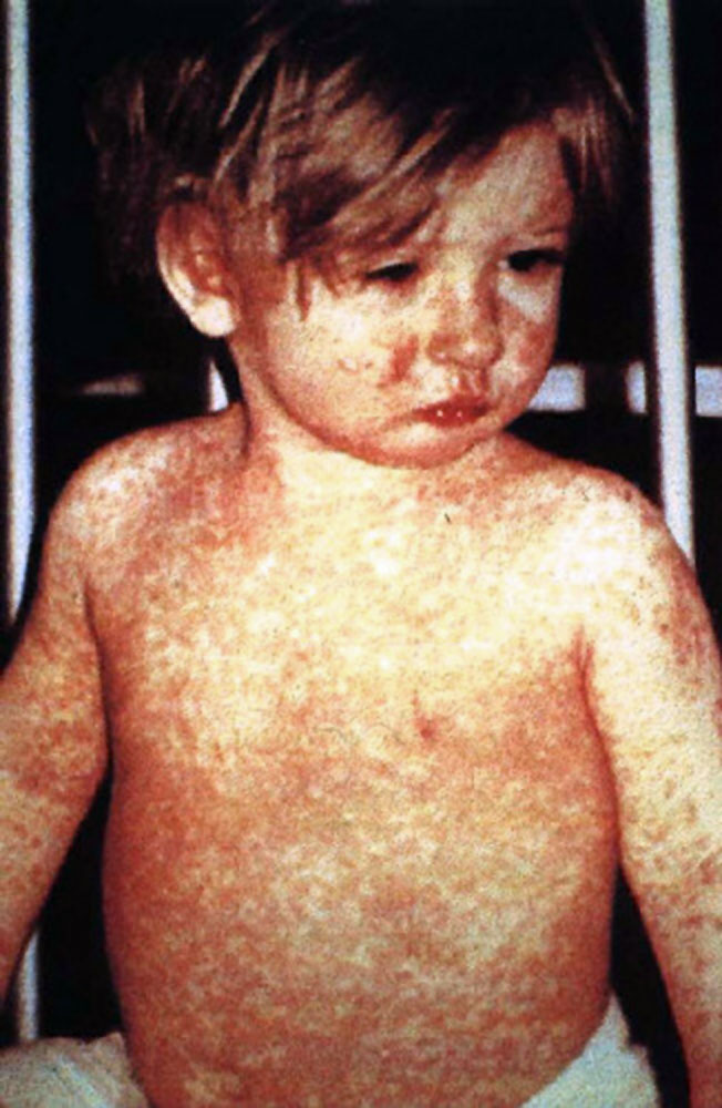 What to know about two new measles cases in California