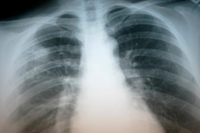 Bay Area county reports rise in tuberculosis cases