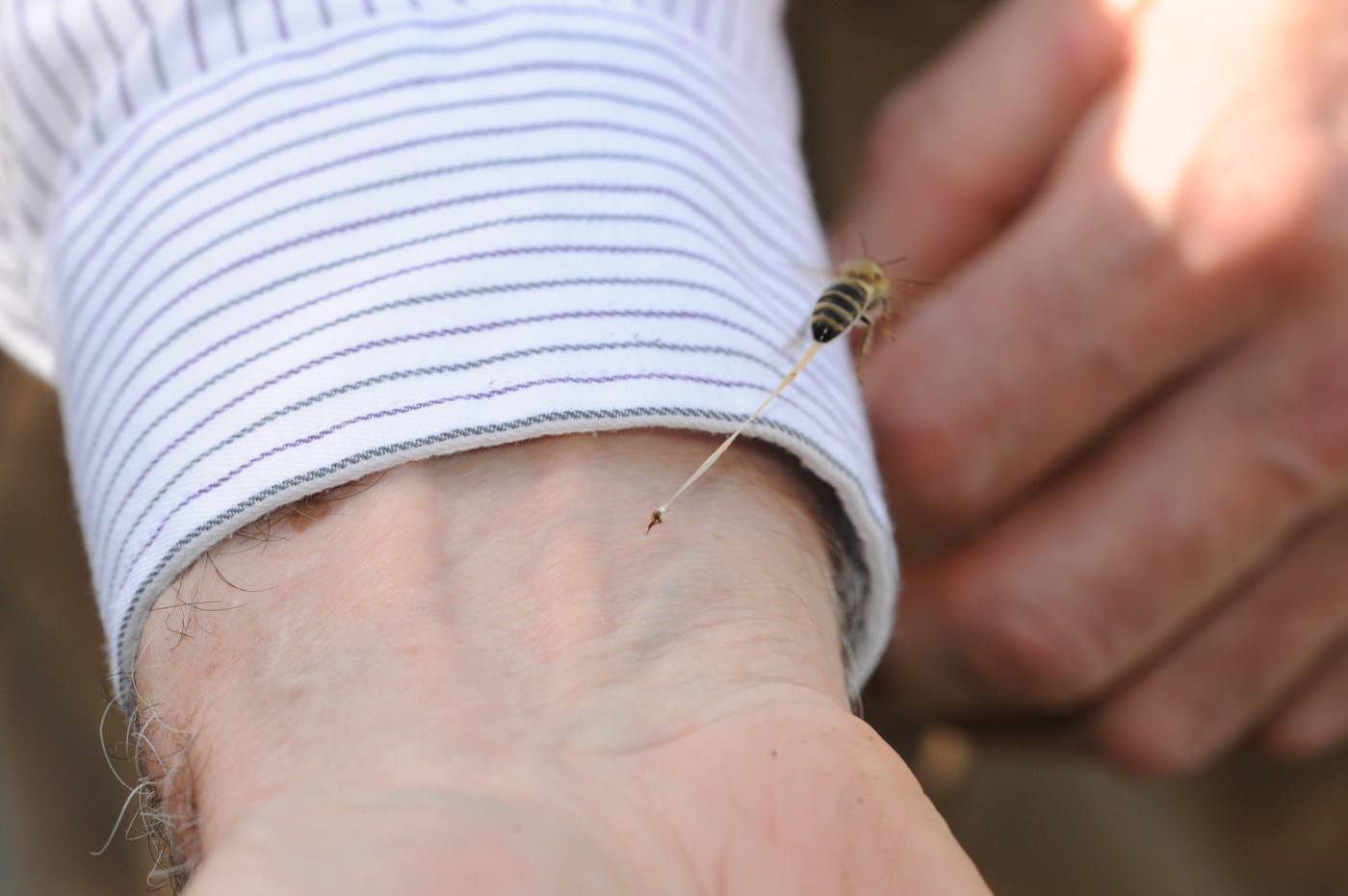 Bay Area plastic surgeon’s novel treatment for bee stings published in medical journal