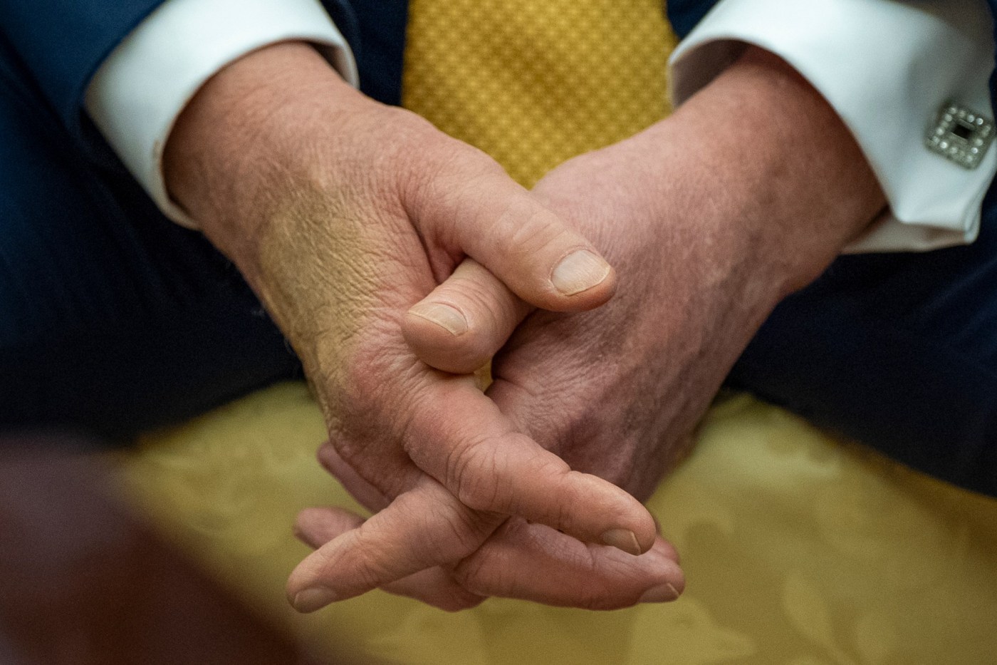 Trump is checked for swelling in legs and was diagnosed with a common condition in older adults